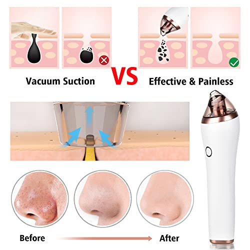 4 in 1 Deep Pore and Blackhead Cleaner